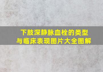 下肢深静脉血栓的类型与临床表现图片大全图解