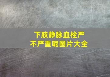 下肢静脉血栓严不严重呢图片大全