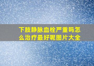 下肢静脉血栓严重吗怎么治疗最好呢图片大全