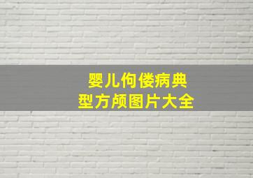 婴儿佝偻病典型方颅图片大全