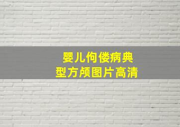 婴儿佝偻病典型方颅图片高清