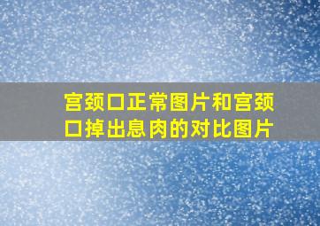 宫颈口正常图片和宫颈口掉出息肉的对比图片