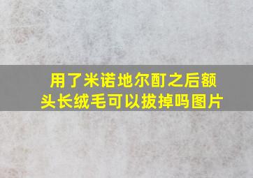 用了米诺地尔酊之后额头长绒毛可以拔掉吗图片