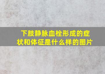 下肢静脉血栓形成的症状和体征是什么样的图片